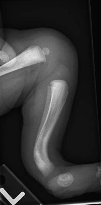 Posteromedial Bowing Of The Tibia | Pediatric Orthopaedic Society Of ...